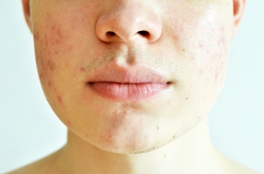 How to Deal With Oily Skin