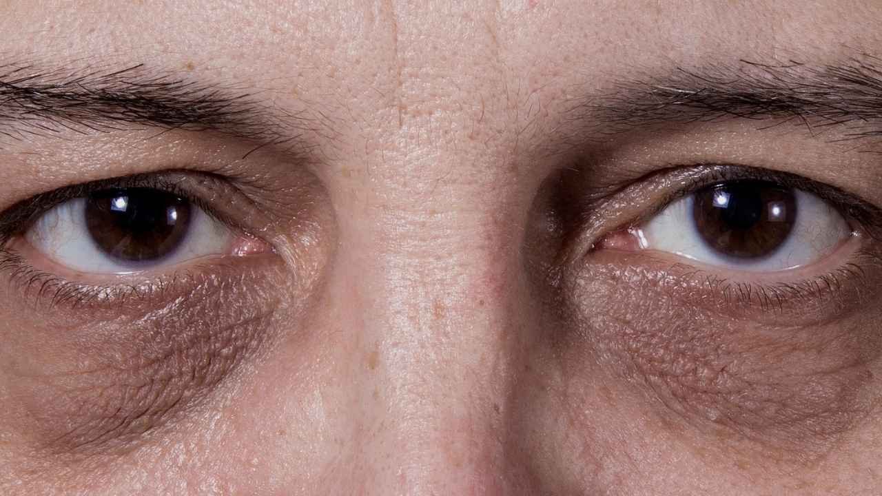 a man with dark circles