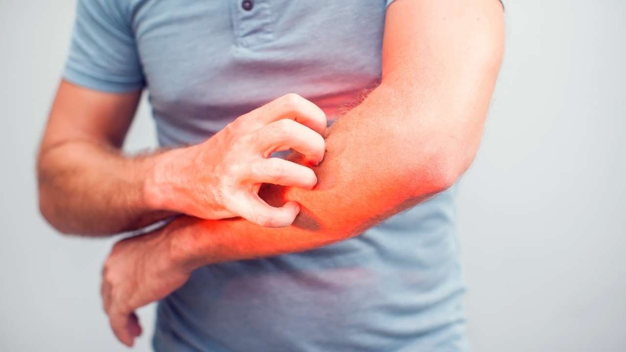 Eczema