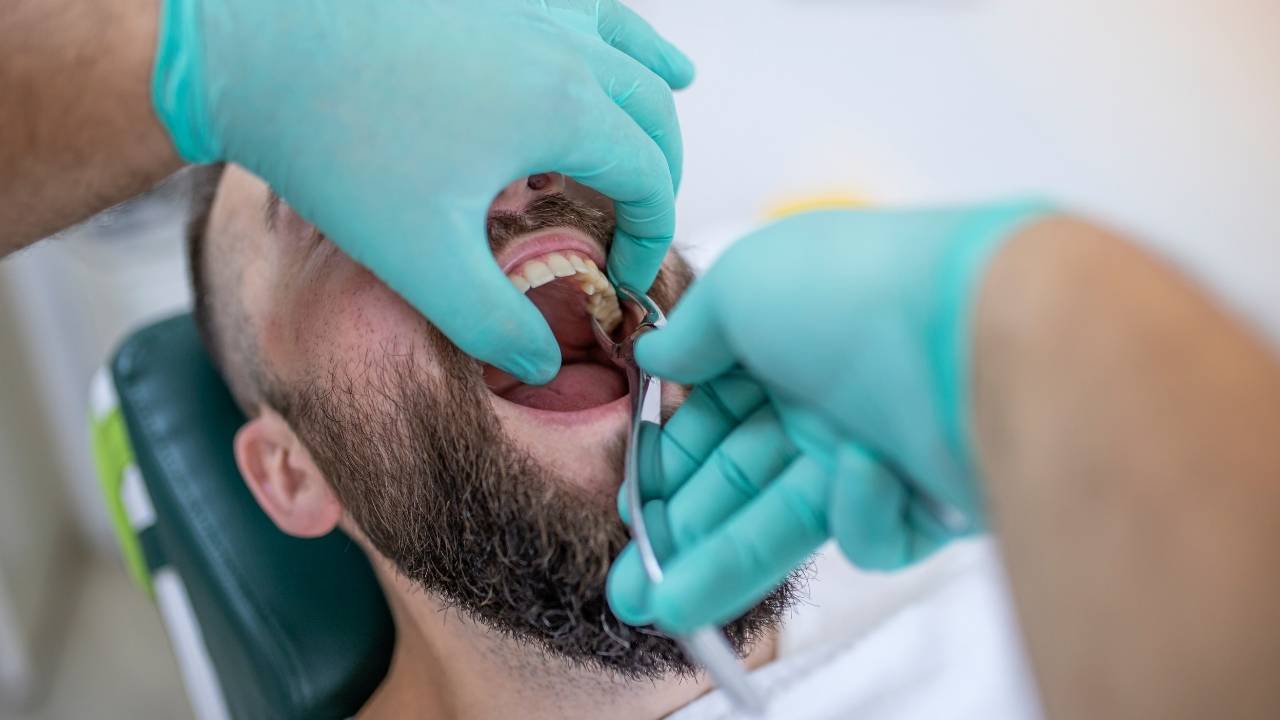 Wisdom Tooth extraction
