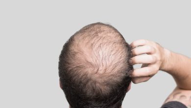 male suffering from Male Pattern Baldness